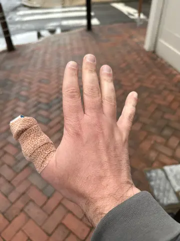 I sprained my thumb