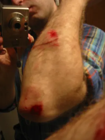 wounds